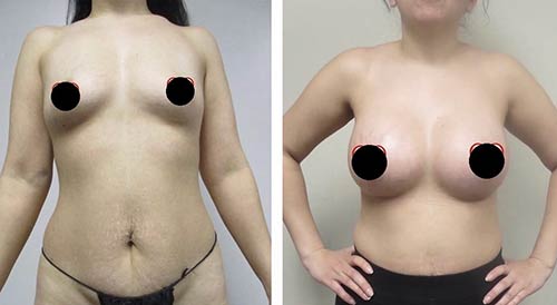 Before and After Breast Augmentation - Lift at Face Works Plastic Surgery, Plastic Surgeon Near Me in Schaumburg, IL