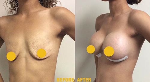Before and After Breast Augmentation - Lift at Face Works Plastic Surgery, Plastic Surgeon Near Me in Schaumburg, IL