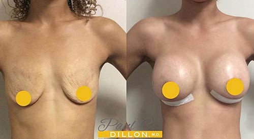 Before and After Breast Augmentation - Lift at Face Works Plastic Surgery, Plastic Surgeon Near Me in Schaumburg, IL