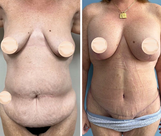 Before and After Mommy Makeover at Face Works Plastic Surgery, Plastic Surgeon Near Me in Schaumburg, IL