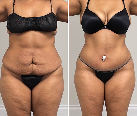 Before and After Tummy Tuck at Face Works Plastic Surgery, Plastic Surgeon Near Me in Schaumburg, IL