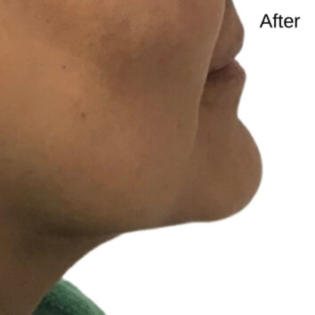 A woman 's face before and after undergoing an upper lip lift.