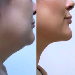 A woman 's face before and after surgery.