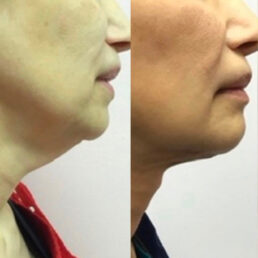 A before and after photo of a woman 's face.